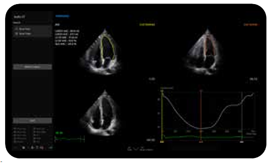 elcamm partner samsung bari ecografi cardiovascolare AutoEF
