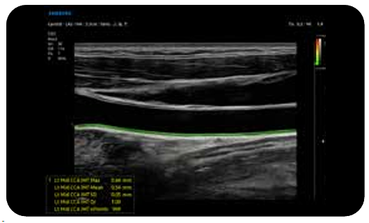 elcamm partner samsung bari ecografi cardiovascolare AutoIMT