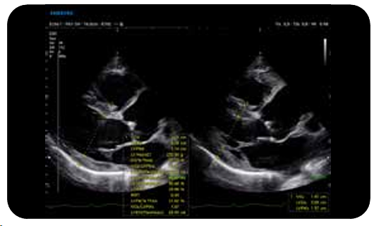 elcamm partner samsung bari ecografi cardiovascolare HeartAssist