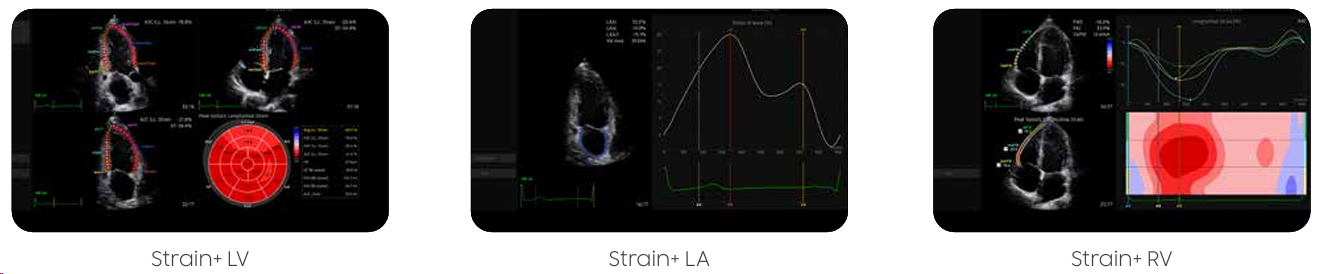 elcamm partner samsung bari ecografi cardiovascolare strain